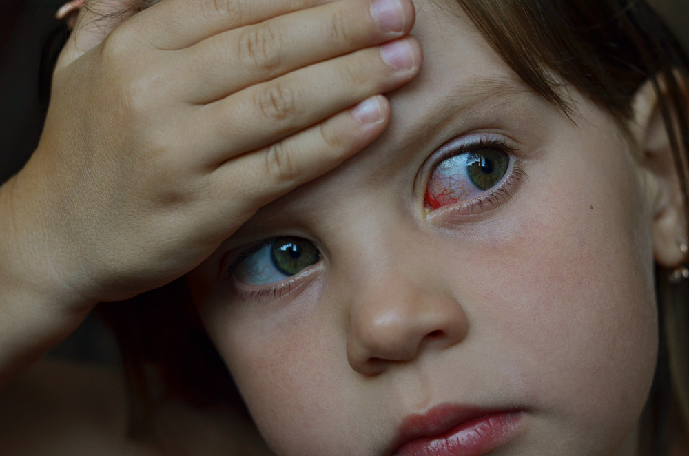 التهاب الملتحمة عند الأطفال؛ أسباب، أعراض، وقاية وعلاج
