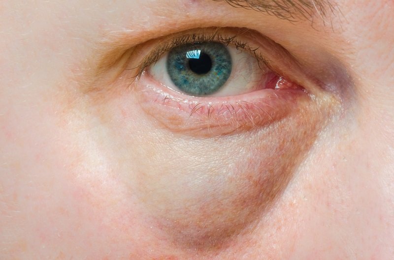جحوظ العينين: حالة طبيعية أم لها أسباب صحية وتحتاج إلى علاج؟