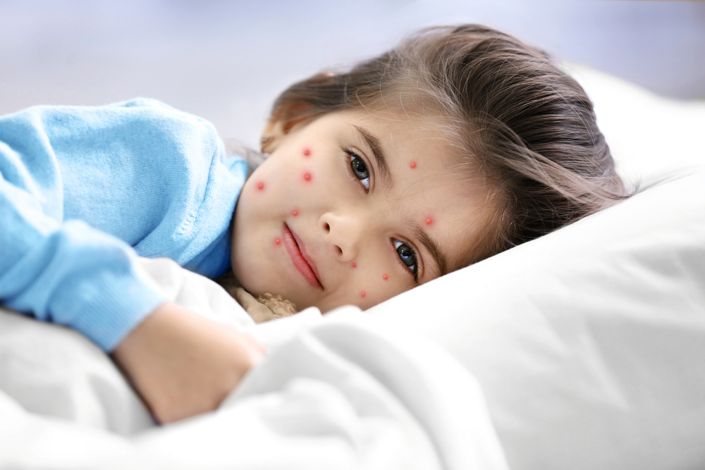 Chickenpox: Symptoms, treatment and prevention