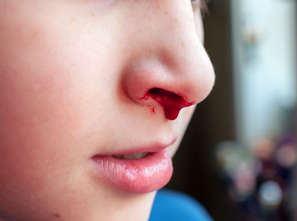 Nosebleeds: Causes and treatment