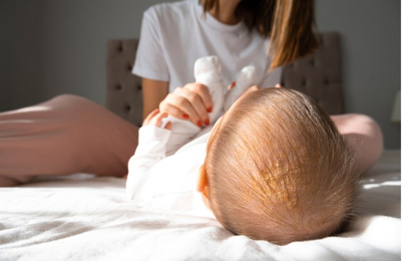 Cradle cap: Causes and ways for treatment