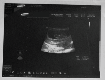 صورة للجنين في الشهر الأول على جهاز الألتراساوند