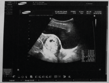 صورة للجنين في الرحم خلال فترة الشهر الثاني من الحمل