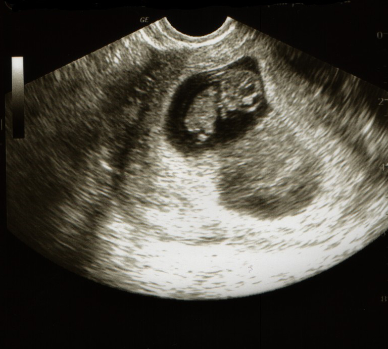 a picture of a baby in the third month on an ultrasound test 